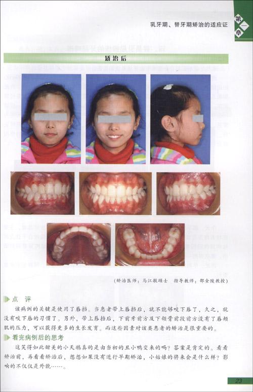 牙颌畸形矫治的适应证.病例展示 免运费