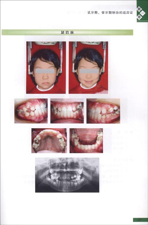 牙颌畸形矫治的适应证.病例展示 免运费