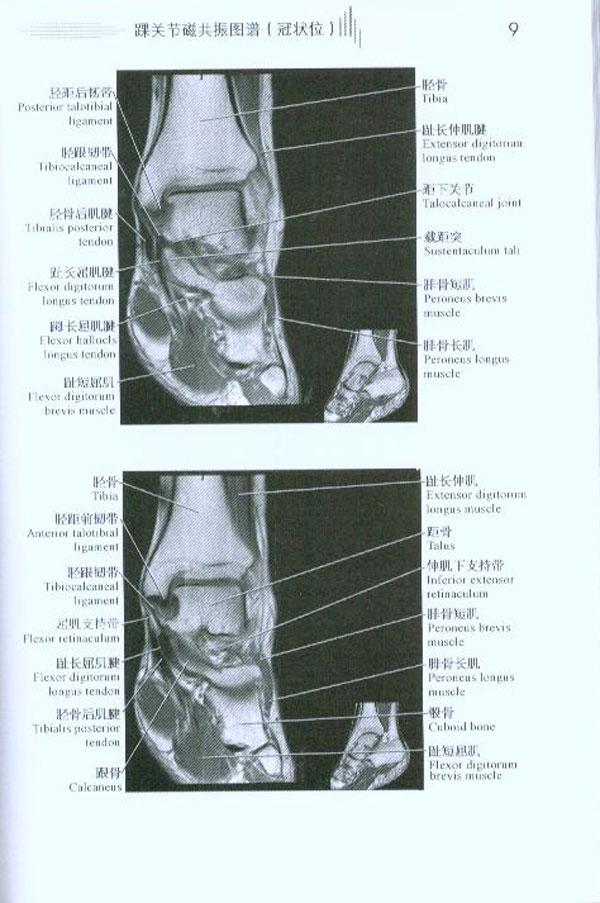 踝关节磁共振图谱(矢状位)   肩关节磁共振图谱(冠状位)   肩关节磁